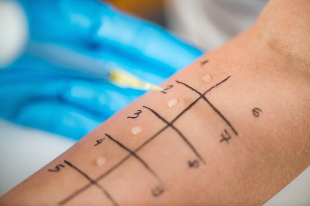Skin Prick Tests on a Woman’s Arm