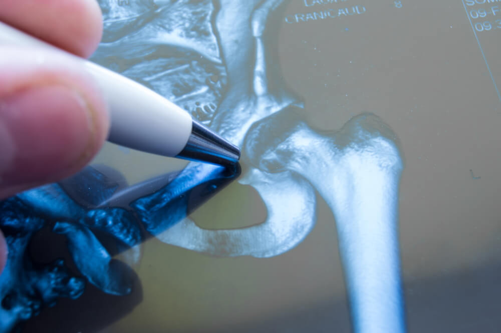 X-ray of hip joint