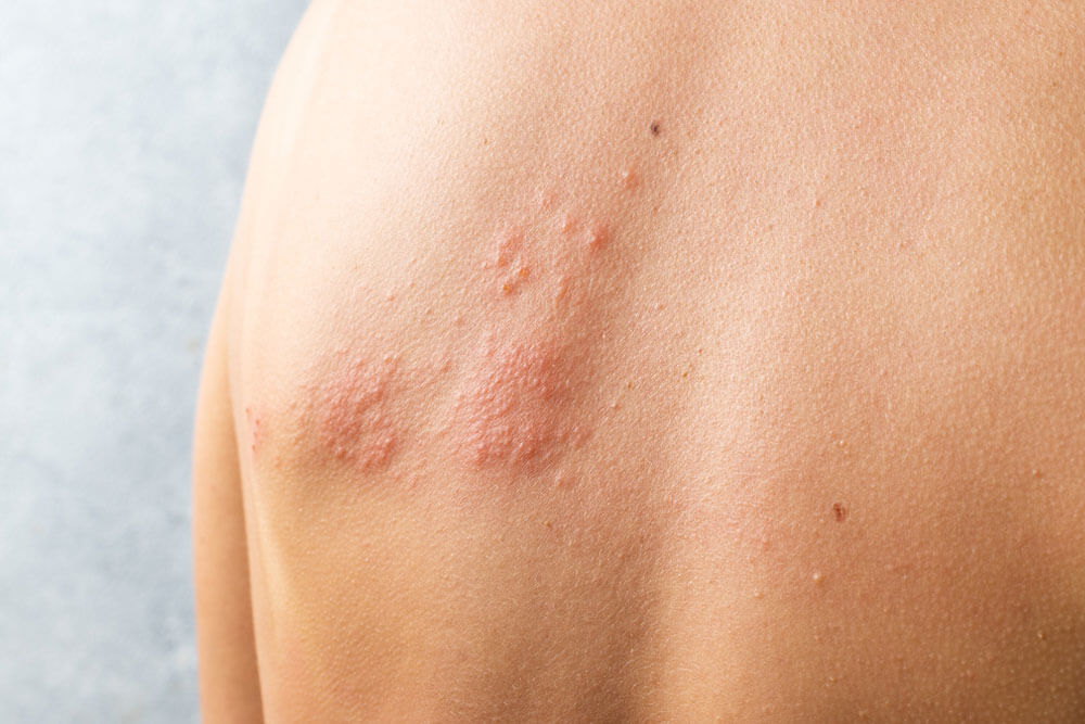 Skin infected Herpes zoster virus