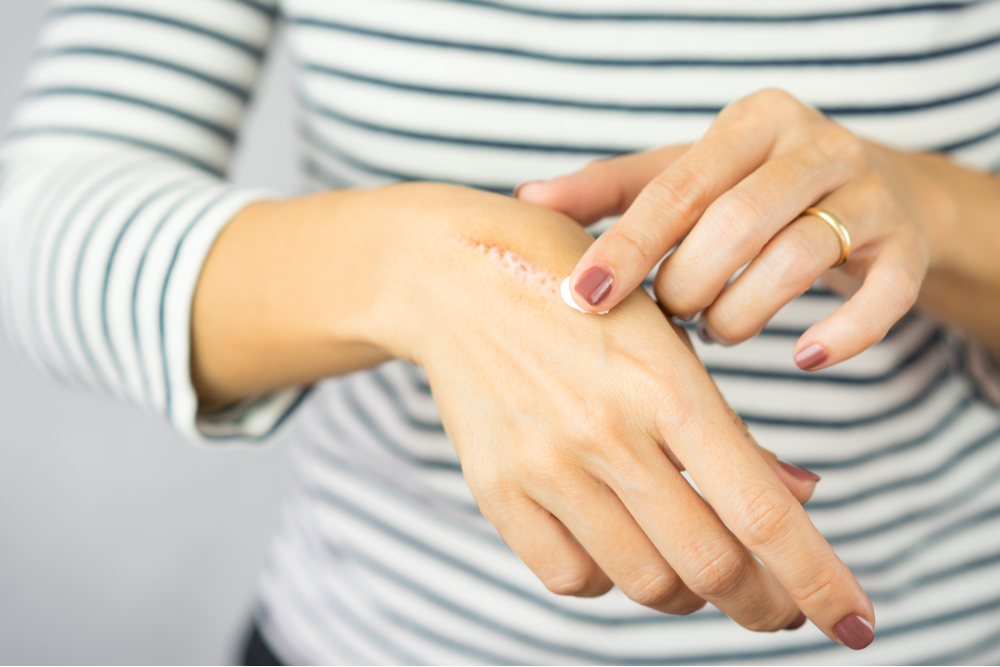 A woman applying scars removal cream to heal