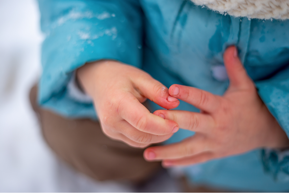 frozen fingers in a child in winter