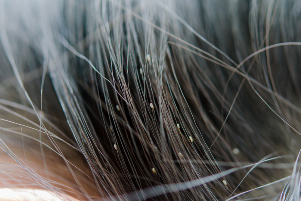 Lice eggs on the child's head